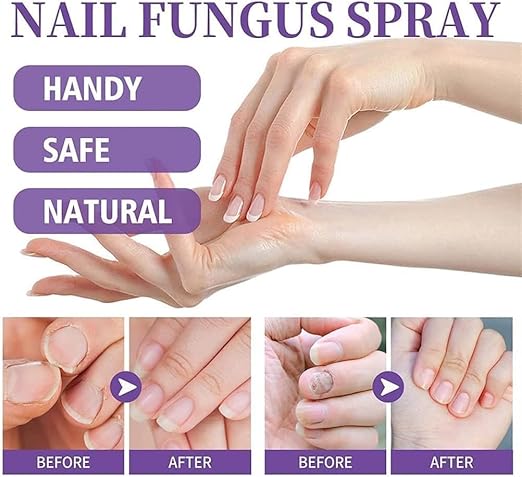 Nail Repair Spray for Damaged Nails – Advanced Antifungal Treatment for Toenails & Fingernails – Restores, Strengthens, and Promotes Healthy Nail Growth – 100ml Foot & Nail Care Solution